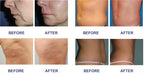 Nova Mart Actimel Venus Legacy skin tightening machine for salon, shown in a professional beauty device setting.